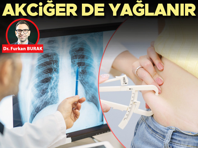 Akciğer Yağlanması Nefes Darlığına Neden Oluyor