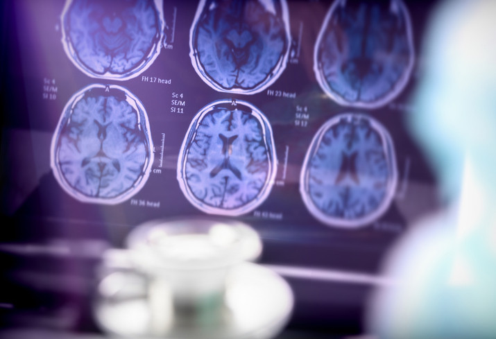 Alzheimer Belirtileri 20 Yıl Önceden Başlıyor: Risk Faktörleri ve Korunma Yolları