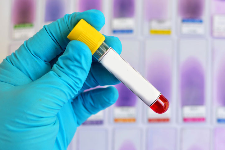 Alzheimer riskini yıllar öncesinden tespit eden kan testi geliyor