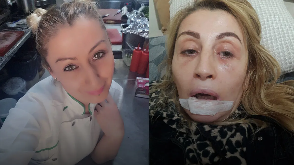 Antalya'da estetik faciası: 7 yıldır adalet bekliyor, dudağı çürüdü