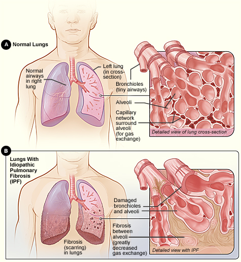 Boehringer Ingelheim Türkiye'den Pulmoner Fibrozis Farkındalık Buluşması