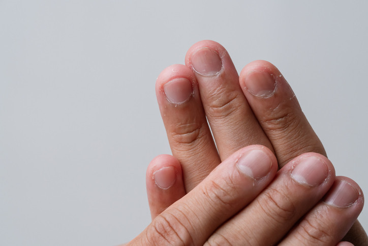 Ciltteki gizli tehlike: Akne sanılan dermatillomani
