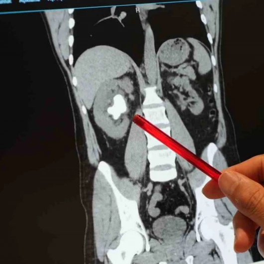 25 cm³ Dev Böbrek Taşı Sırt Deliğinden Çıkarıldı