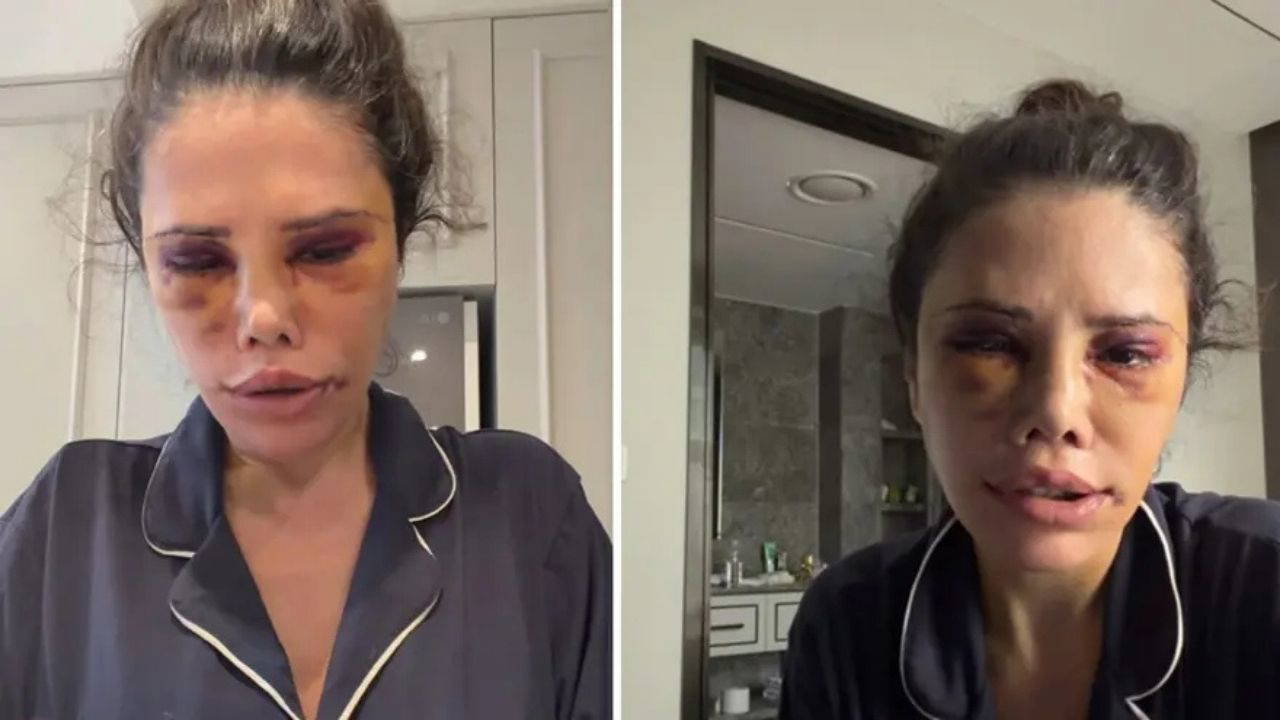 Didem Ceran Güney Kore'deki estetik ameliyatını anlattı: Deri altındaki kan duruyor