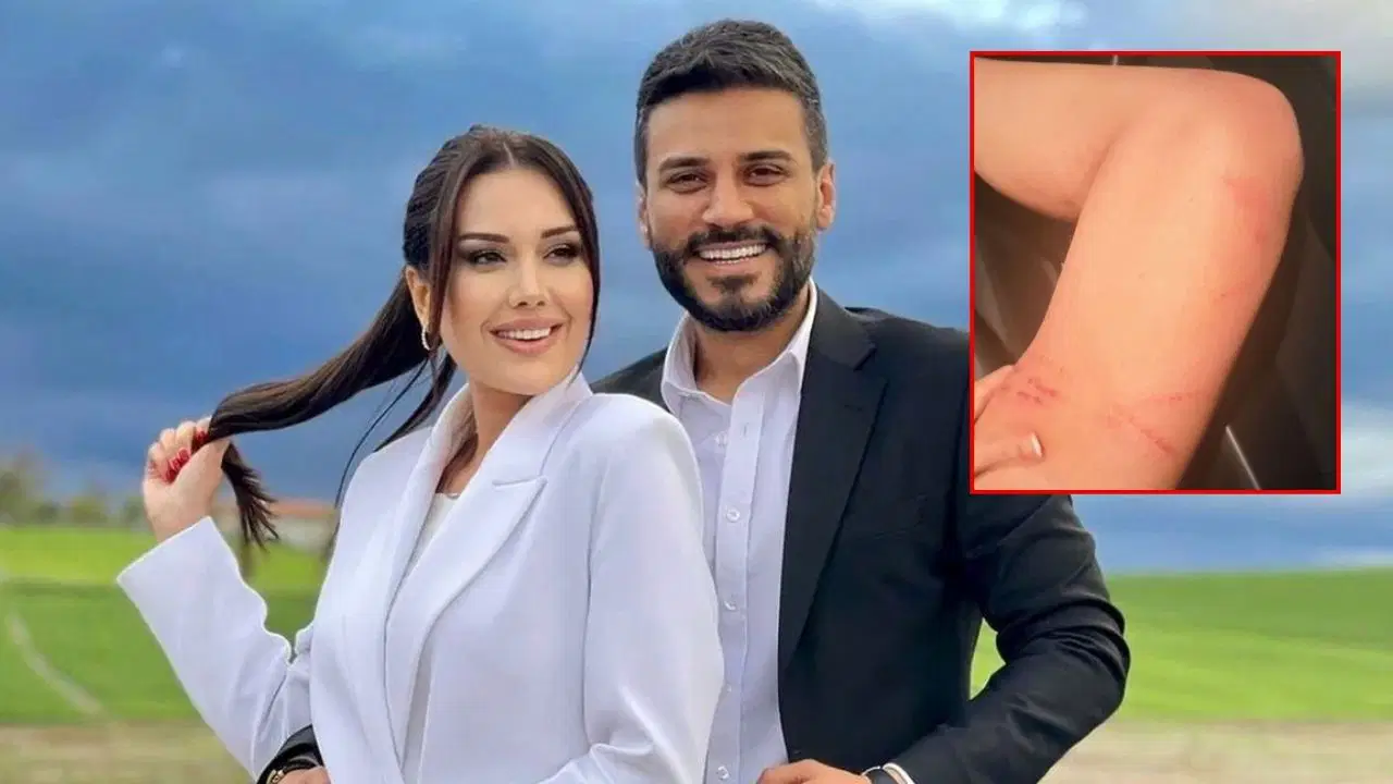 Dilan Polat darp izlerini paylaşıp sildi: Engin Polat'a 'Boşanacaksın oğlum benden' dedi