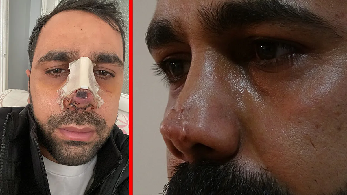 Diyarbakır’da estetik faciası: Burun ameliyatı sonrası hayatı karardı