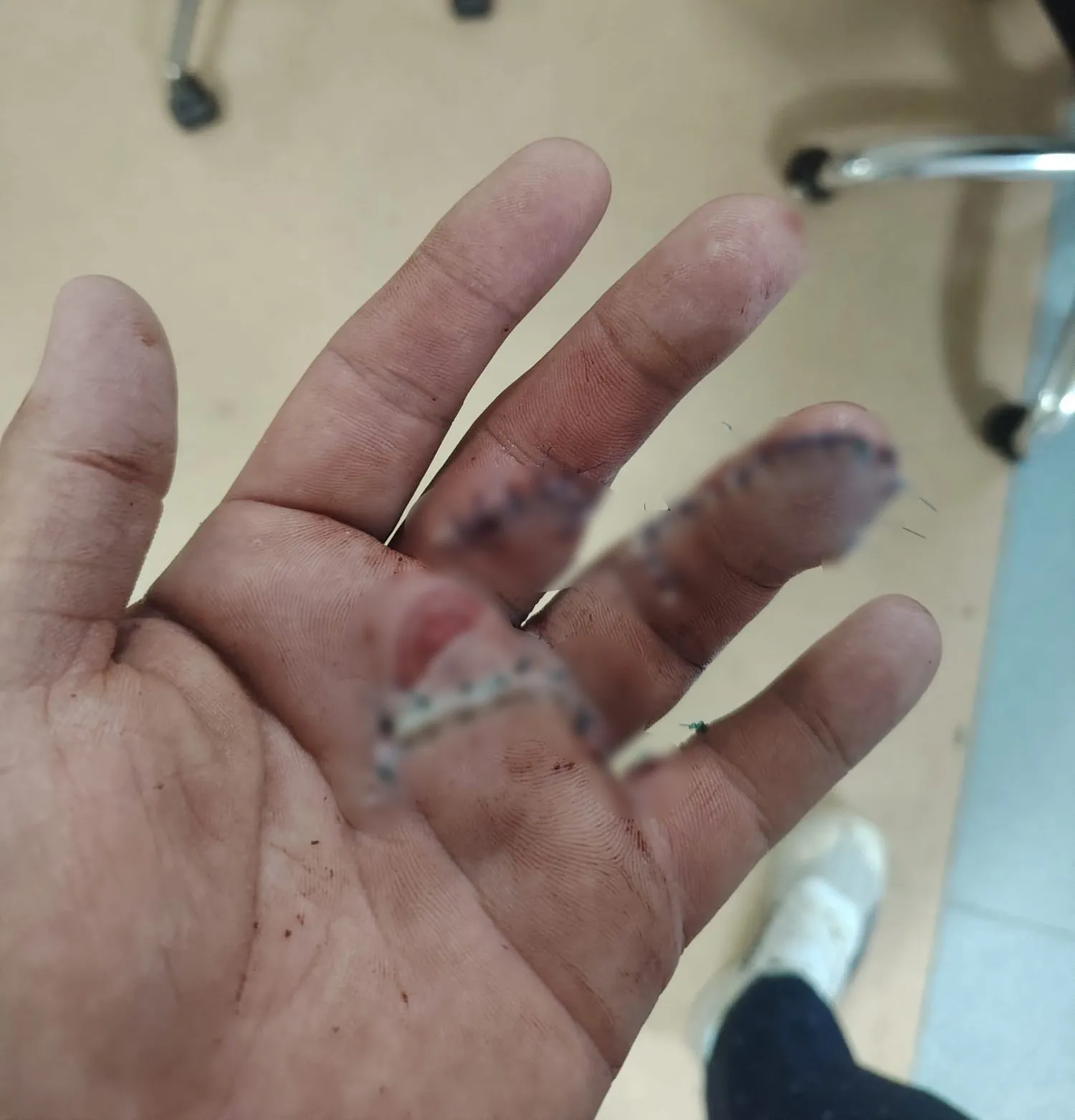 Döner Bıçağıyla Dehşet: 2 Parmağı Koptu