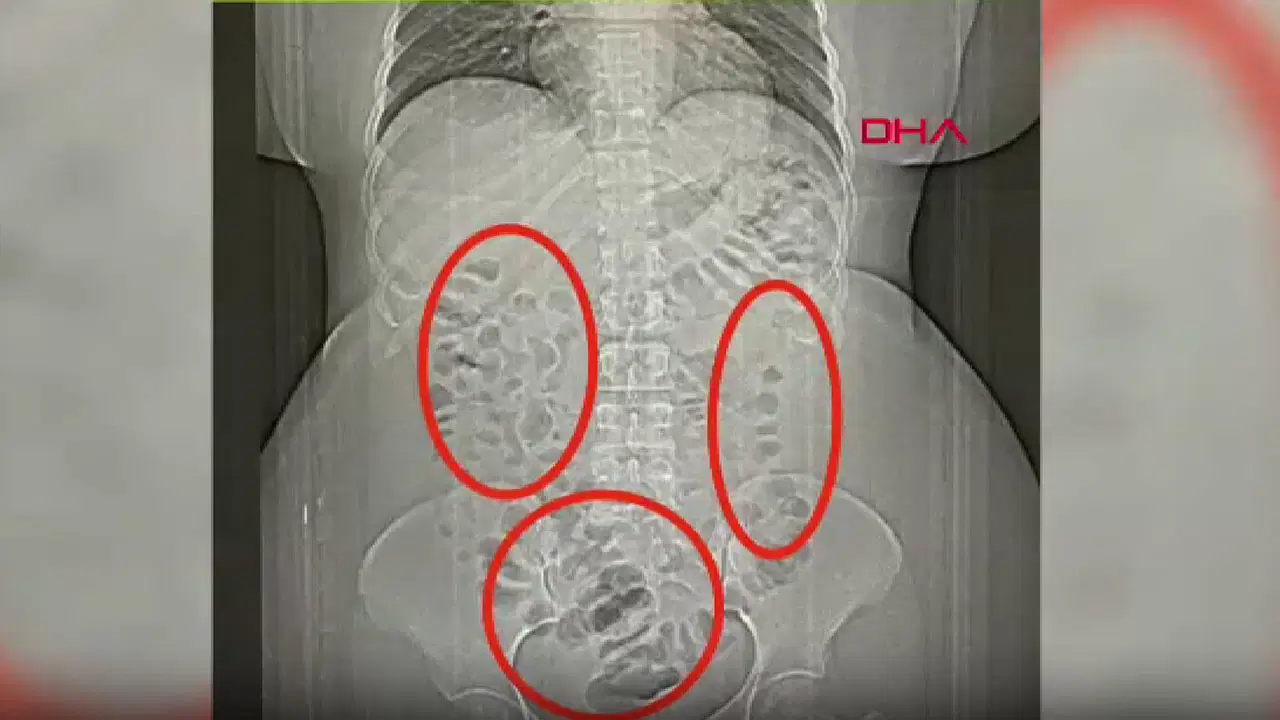 Eskişehir'de Mide ve Bağırsaklarda 432 Gram Metamfetamin Ele Geçirildi