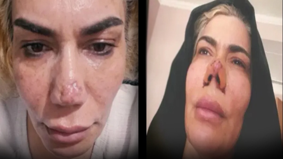 Estetik Operasyonu Faciası: Burnu Yırtılan Kadının Dramı