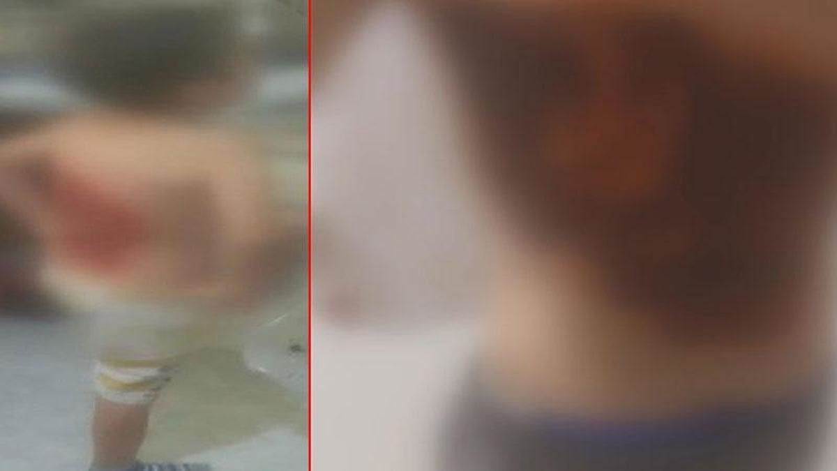 İstanbul Arnavutköy'de 12 Yaşındaki Çocuk Ateşe Verildi