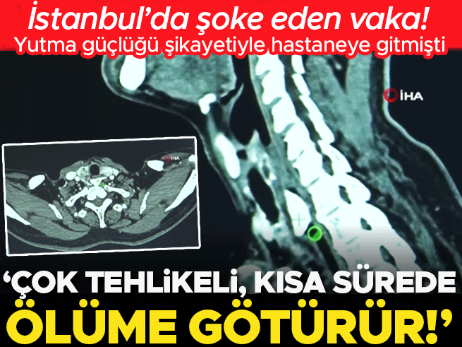 İstanbul'da şoke eden olay: Yutma güçlüğü şikayetiyle hastaneye gitti, yemek borusundan kemik çıktı