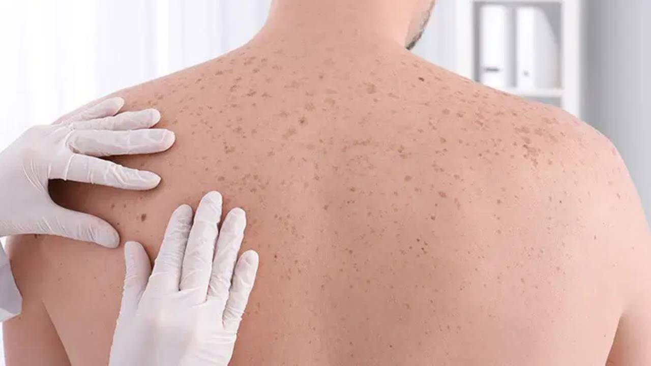 İyileşmeyen Yaralar Cilt Kanserinin Habercisi Olabilir