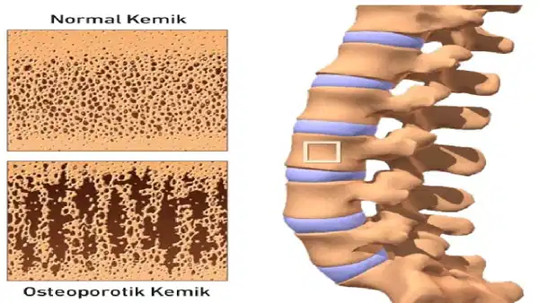 Kemik Erimesinde Sessiz Tehlike: Kırık Riski %50'yi Aşıyor