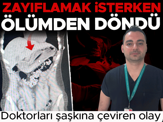 Kilo vermek isterken yuttuğu diş fırçası midesinden çıkarıldı