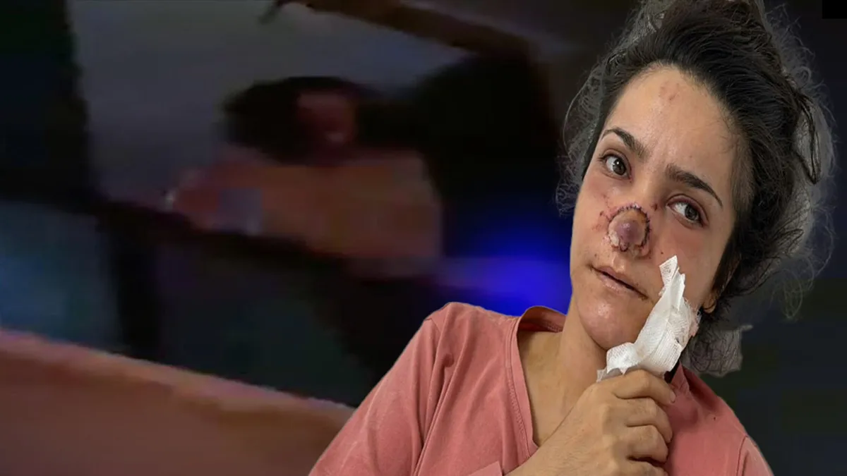 Manisa'da cani koca dehşeti: Tartıştığı eşinin burnunu ısırıp kopardı