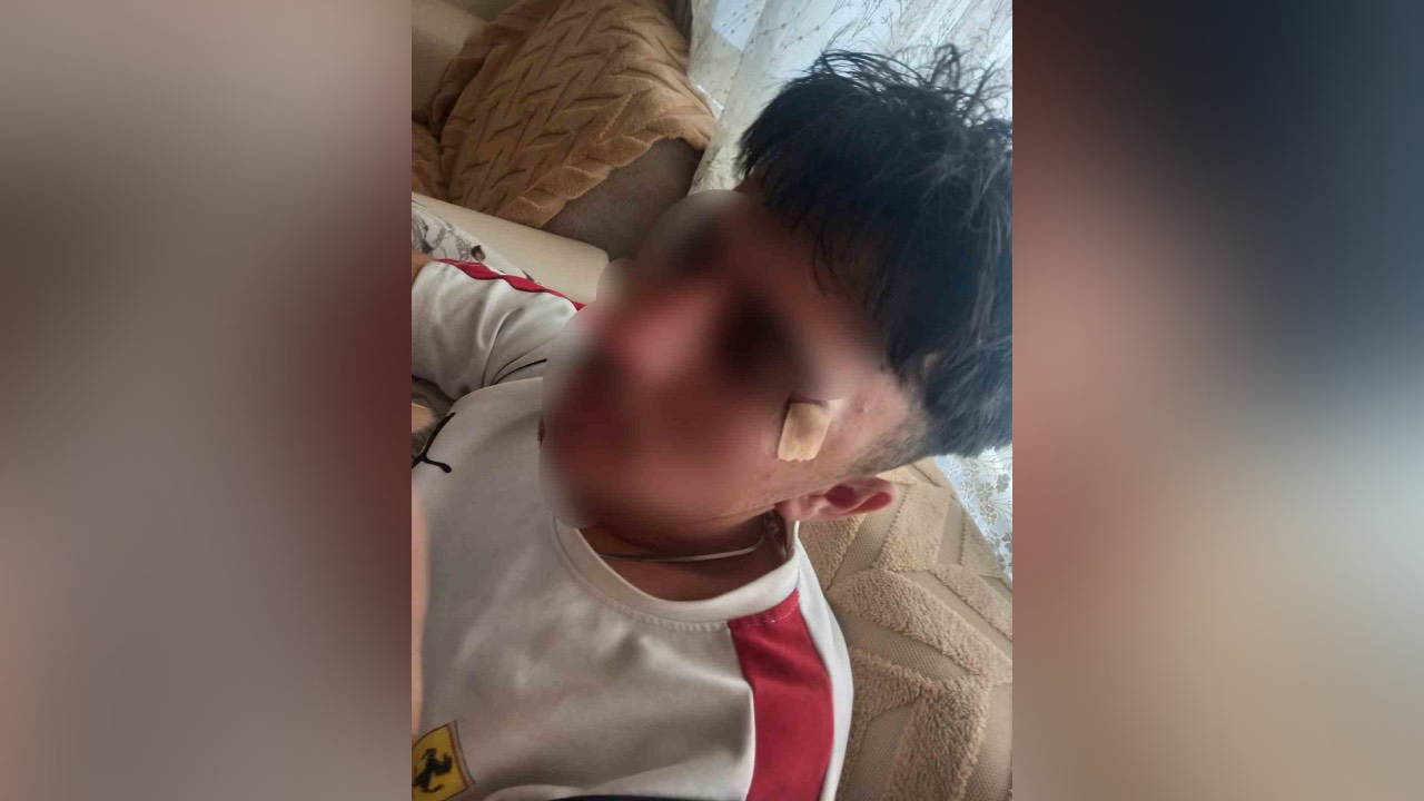MESEM'de Çocuğa Şiddet: Öğretmen Öğrencinin Burnunu Kırdı