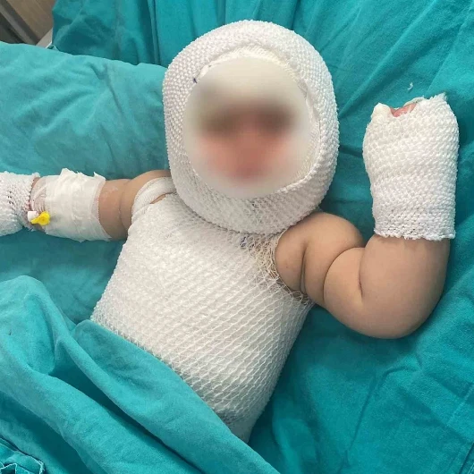 Misafirlikte Mutfak Kazası: Eliz Bebek 3. Derece Yanıklardan Kurtuldu