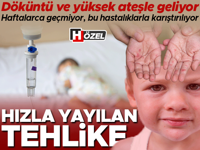 Okullarda hızla yayılan virüs: Döküntü ve yüksek ateşle geliyor, bu hastalıklarla karıştırılıyor