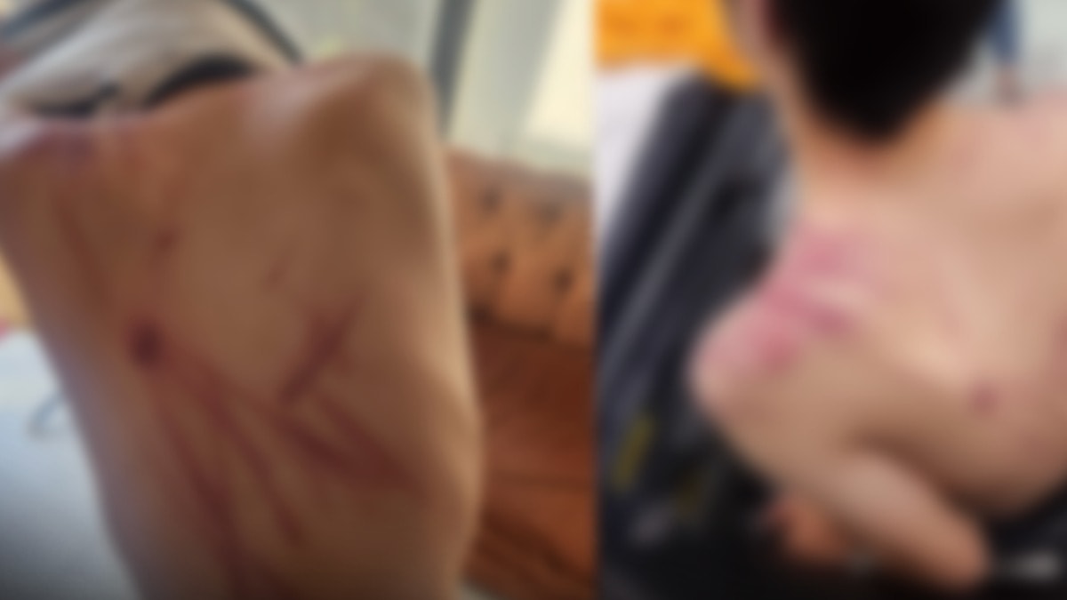 Rehabilitasyon Merkezinde Down Sendromlu Çocuğa İşkence İddiası