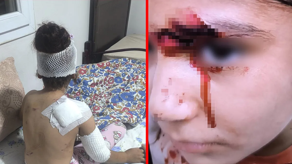 Şanlıurfa'da başıboş köpekler 8 yaşındaki çocuğa saldırdı: 150 dikiş