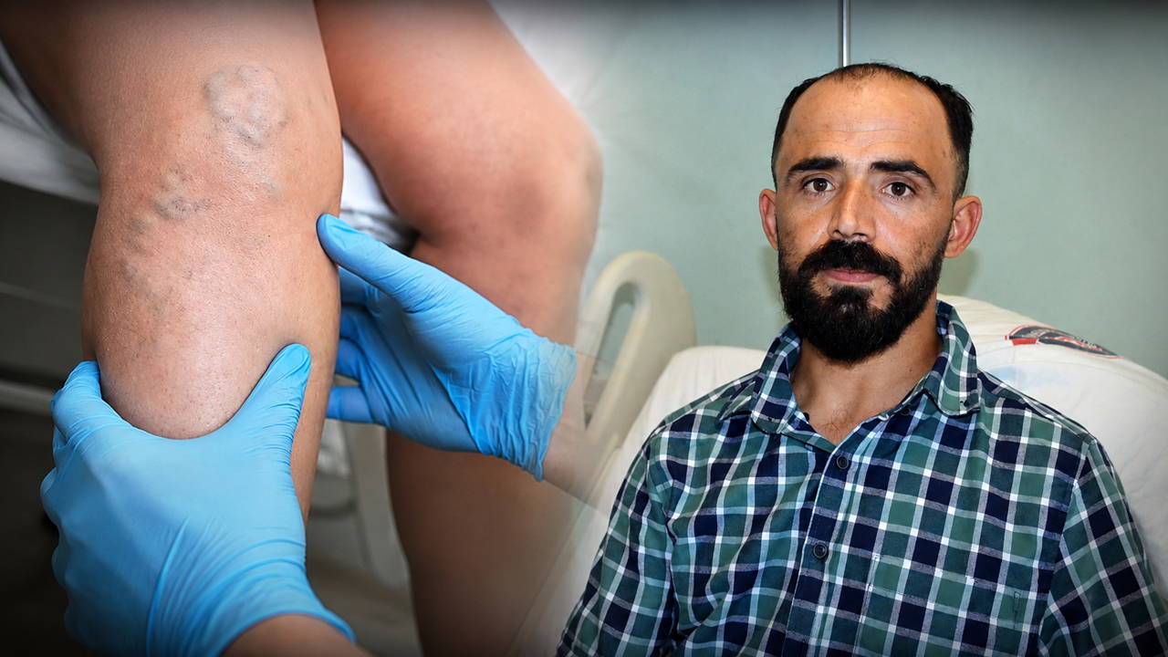 Sedef hastası Yusuf Baynal'ın atardamarı yırtıldı: Dünyada birkaç vaka var