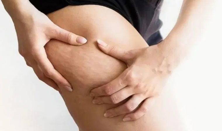 Selülit mi lipödem mi? Bacak sağlığında kritik ayrım