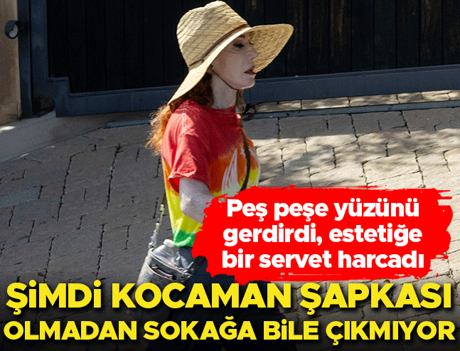 Üç Kez Yüzünü Gerdirdi, Servet Harcadı: Şimdi Şapkasız Sokağa Çıkamıyor