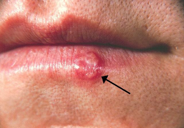 Uçuk virüsü yüzünden epilepsi oldu! Akrabasının öptüğü Atlas ölümden döndü