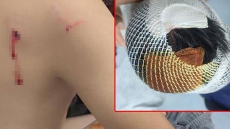 Viranşehir'de Başıboş Köpek Saldırısı: 8 Yaşındaki Çocuk 15 Dikişle Kurtuldu