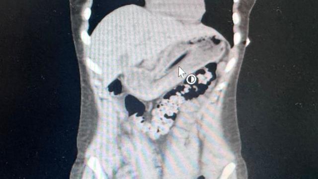 Zayıflamak isterken 13 cm'lik diş fırçasını yuttu, ameliyatla çıkarıldı