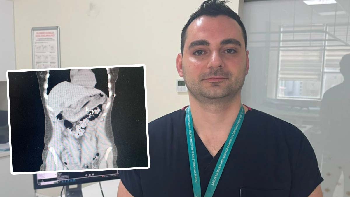 Zayıflamak isterken 13 cm'lik diş fırçasını yuttu: Doktorlar bile şaşkın